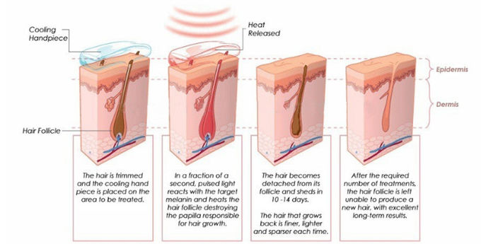Il CE ha approvato la macchina della casa di depilazione del laser per il corpo intero, l'alimentazione elettrica 2000W